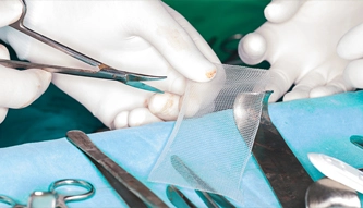 surgeons prepping mesh